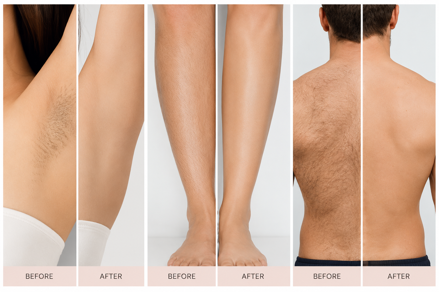 Before and after laser hair removal — underarm, legs, and back — Elite Laser Services Saskatoon