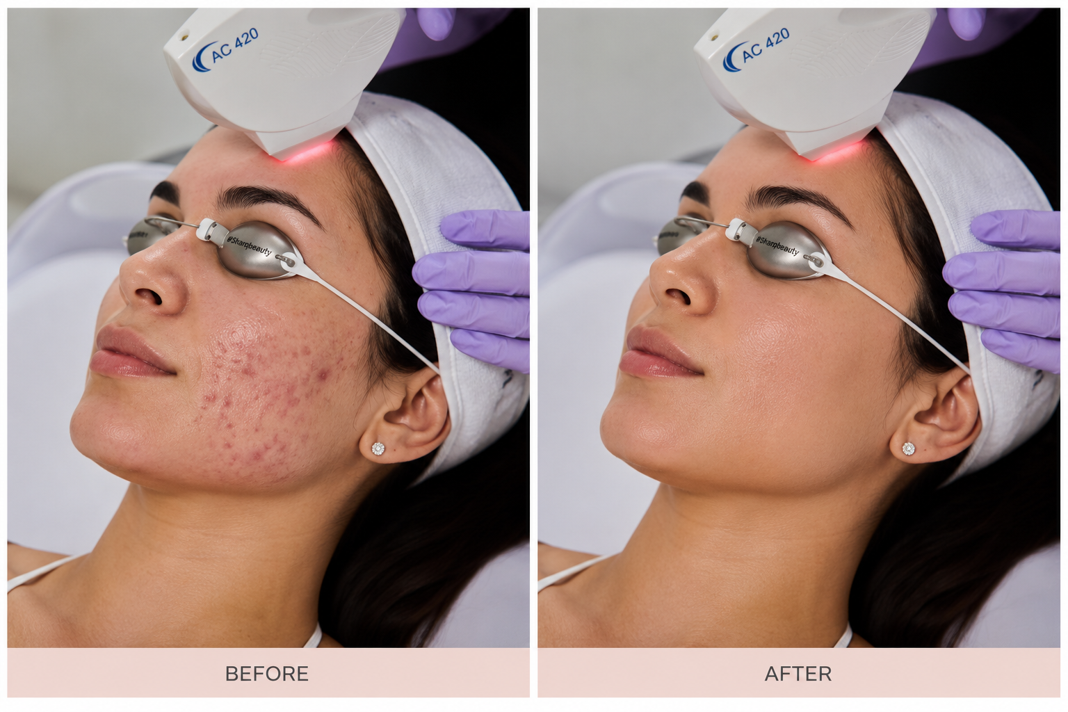 Before and after acne treatment — visibly clearer skin — Elite Laser Services Saskatoon