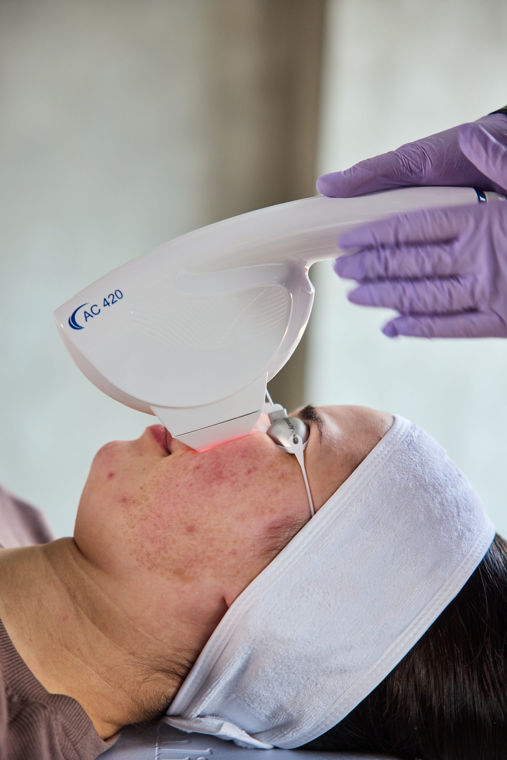 Acne treatment — Elite Laser Services Saskatoon