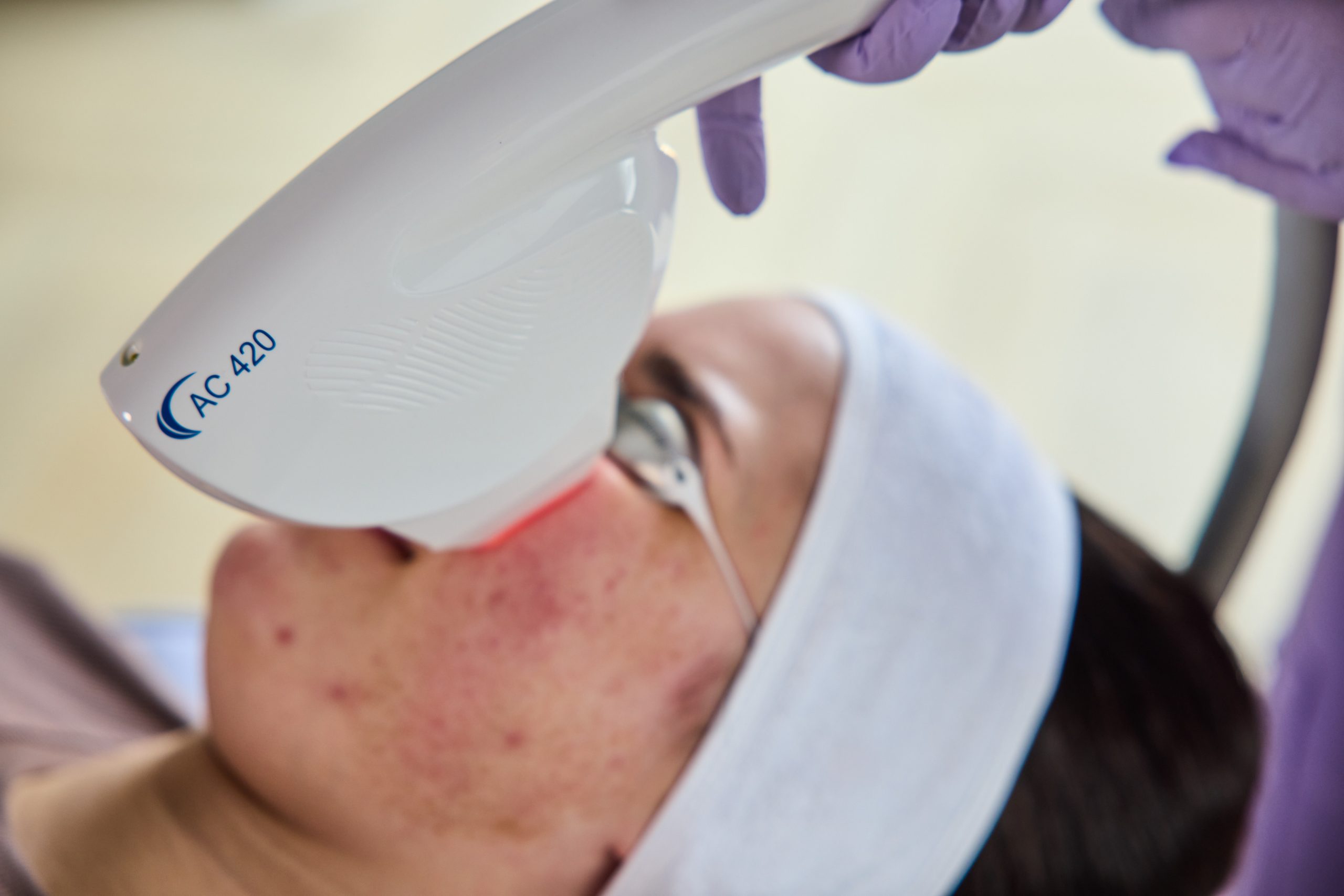 DPC acne treatment — Elite Laser Services