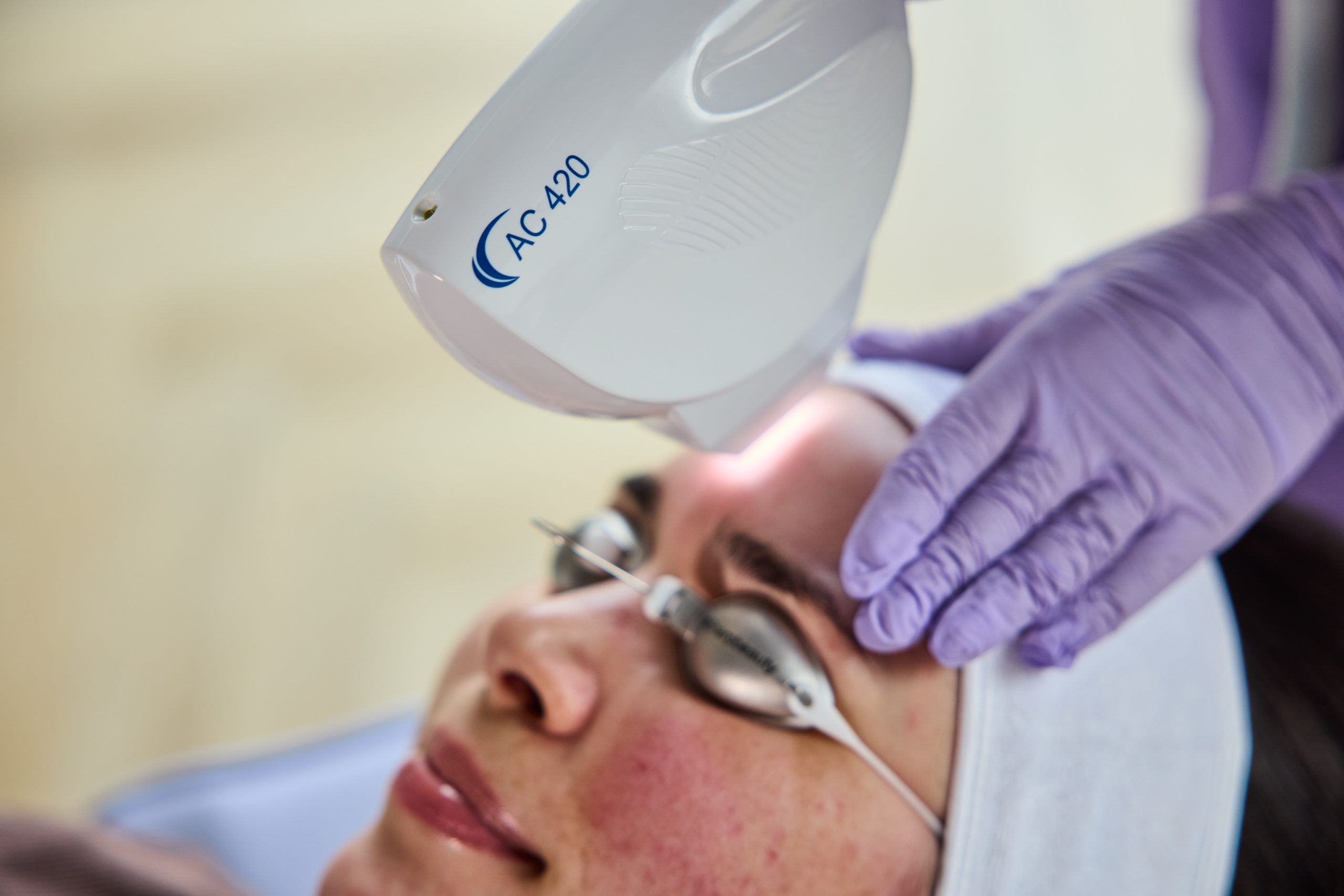 SharpLight AC 420 acne treatment — Elite Laser Services