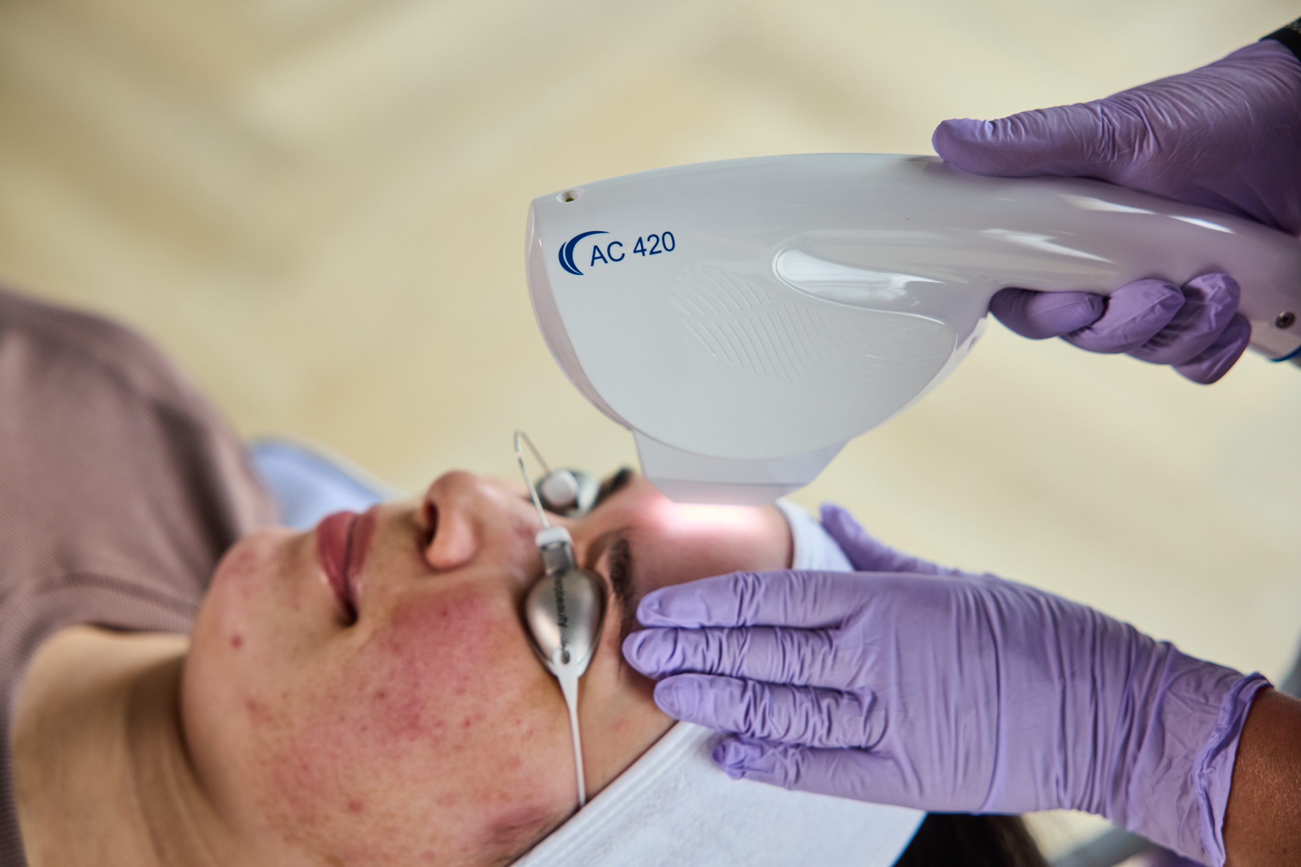Acne treatment clinic — Elite Laser Services Saskatoon