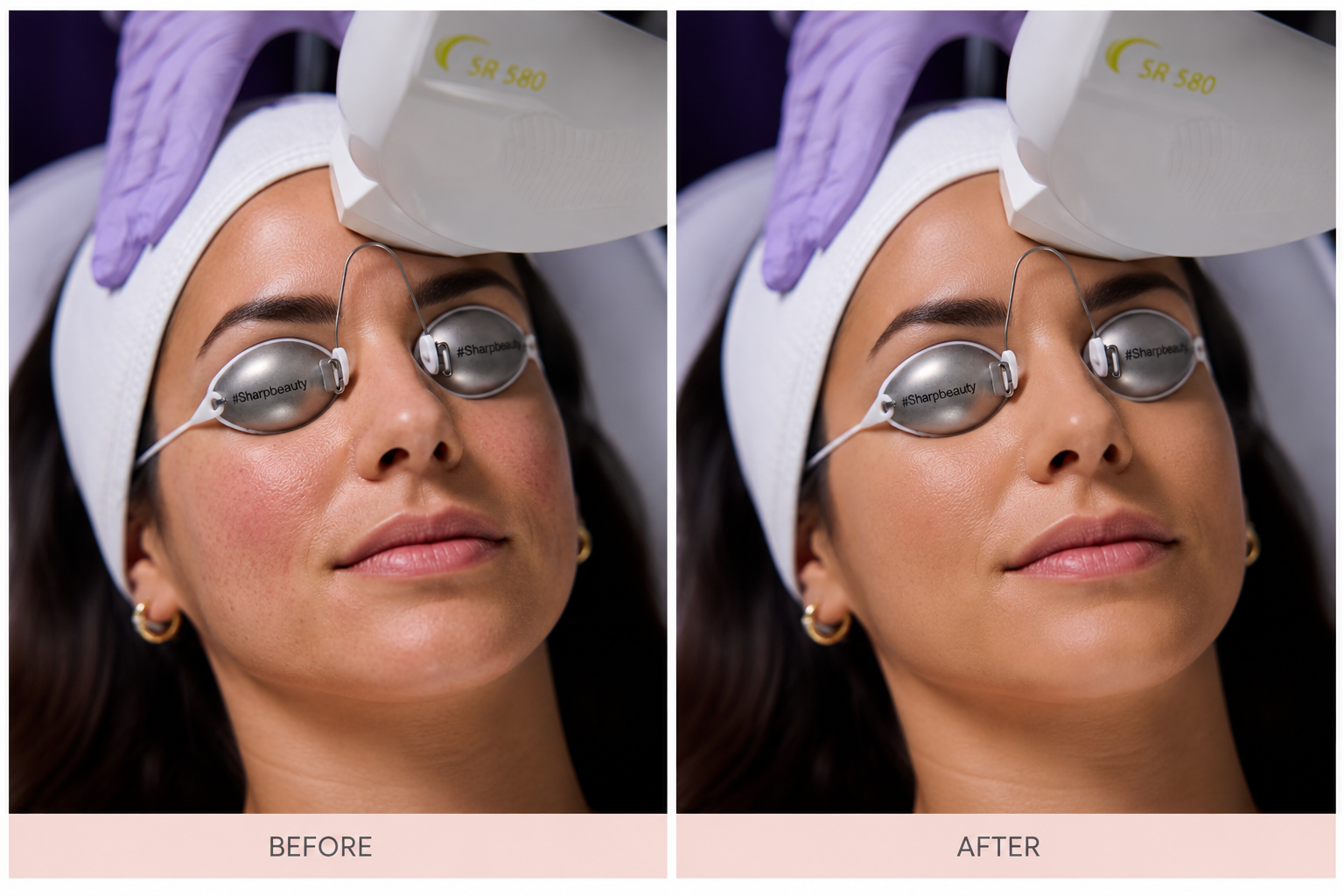 Before and after skin rejuvenation — reduced redness and improved skin tone — Elite Laser Services Saskatoon