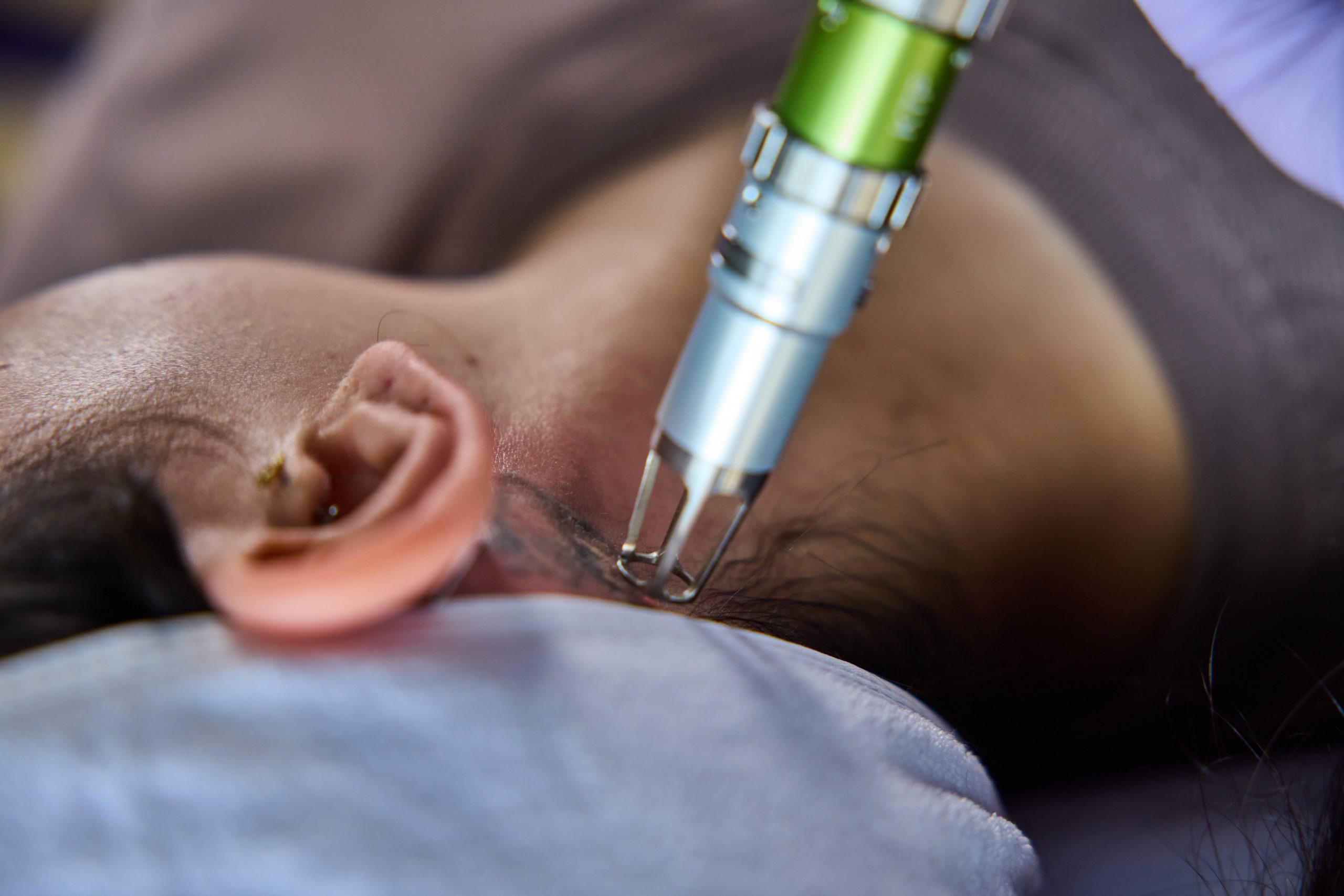 Tattoo removal treatment — Elite Laser Services Saskatoon