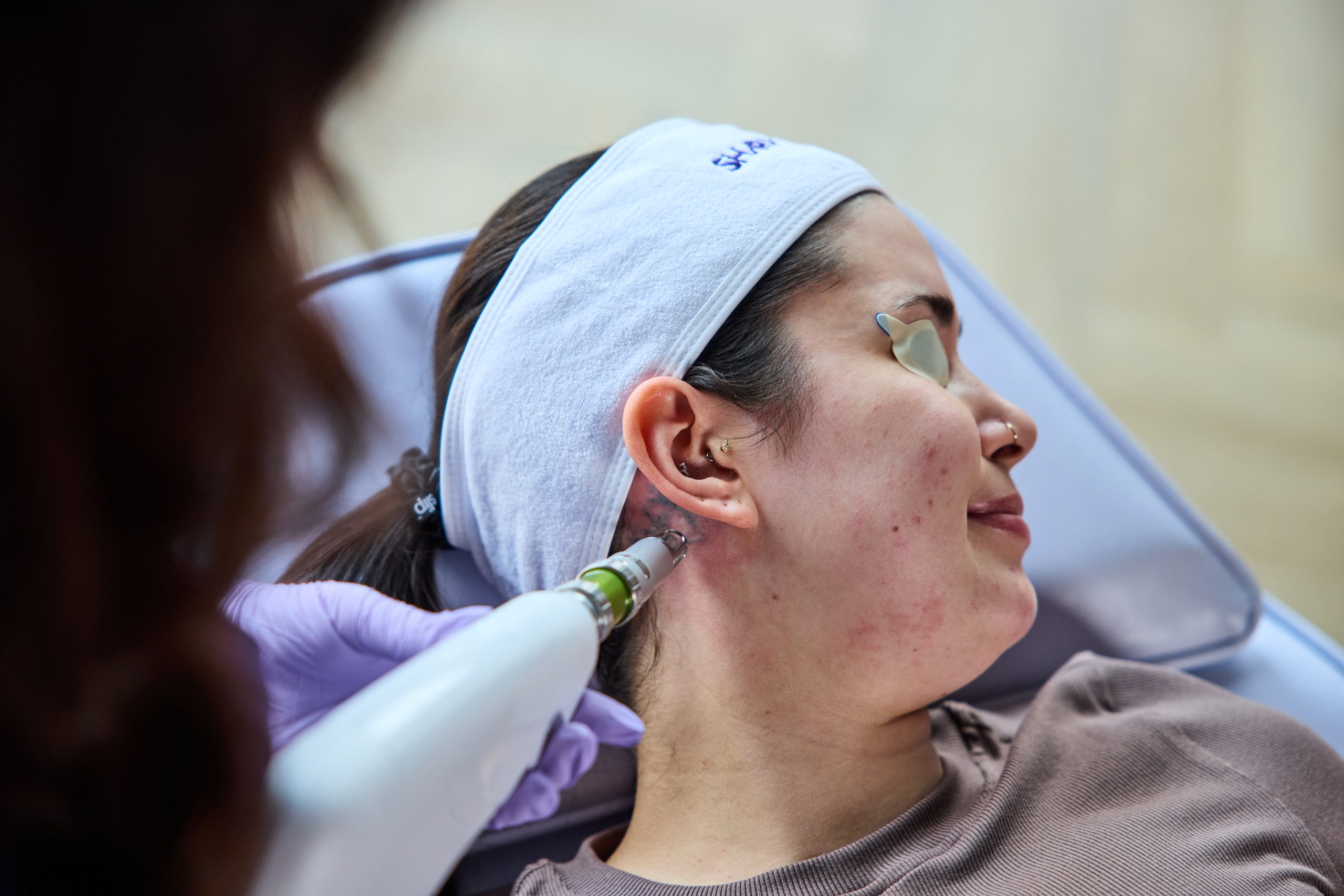 Tattoo removal clinic — Elite Laser Services Saskatoon