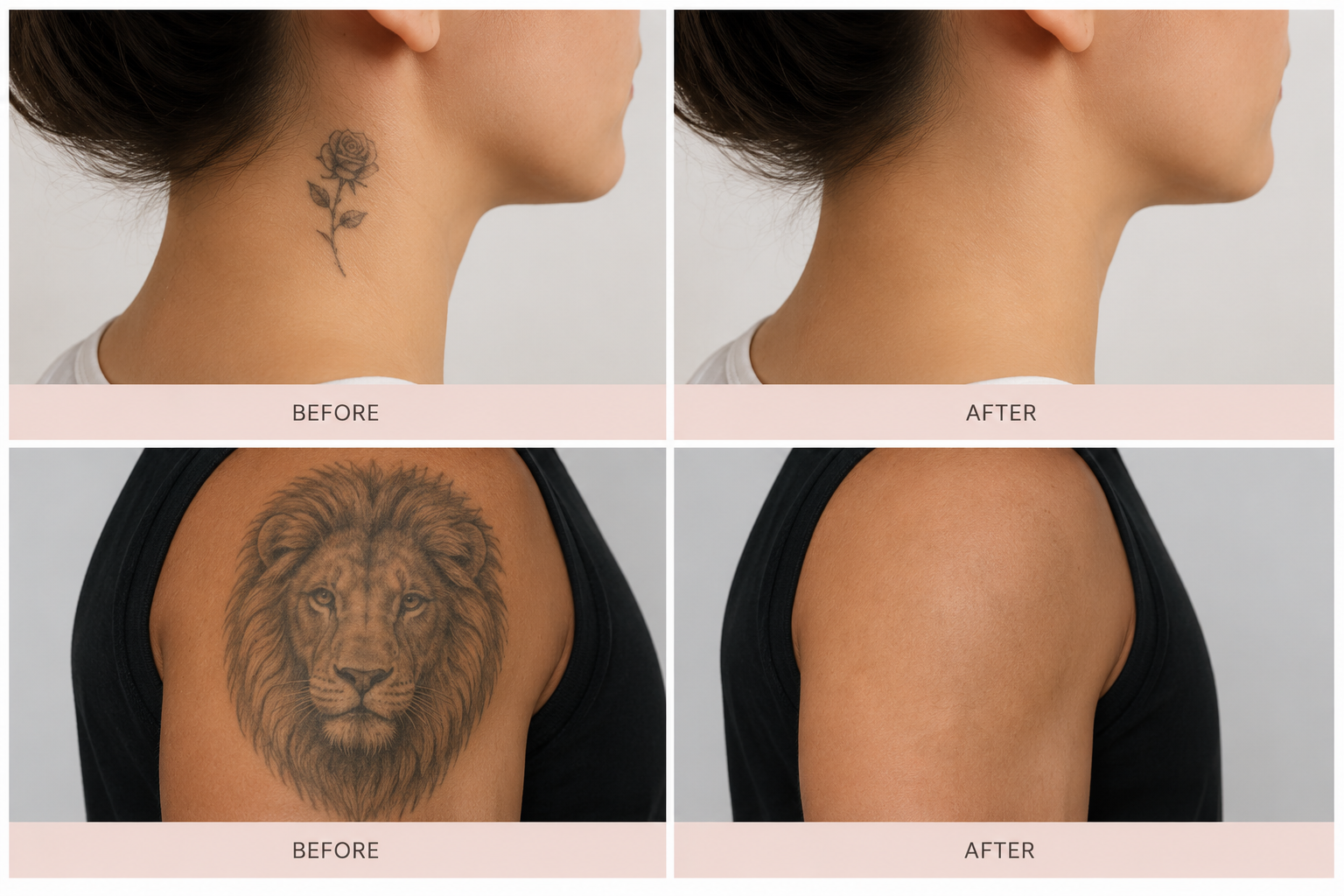 Before and after tattoo removal — neck rose and shoulder lion tattoos — Elite Laser Services Saskatoon